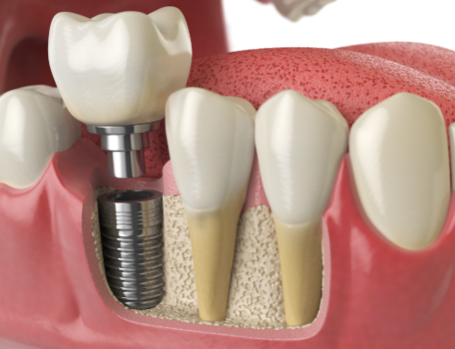 The Importance of Replacing Lost Teeth and Why You Should Consider It Now